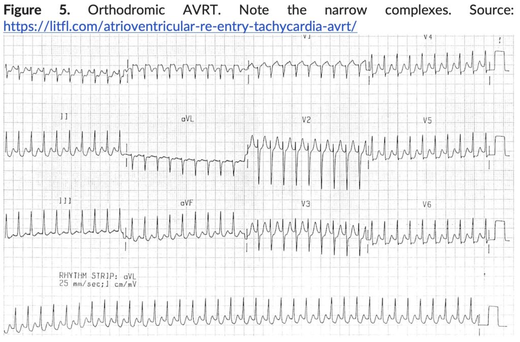 Figure 5. Orthodromic AVRT.